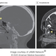 Una tomografía computarizada del cerebro de la mujer tomada en 2017 reveló su raro defecto congénito, pero no se notó hasta después de que una prueba de frotis nasal para el covid-19 probablemente lo dañó y provocó la fuga de líquido cefalorraquídeo.
